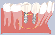 インプラントイメージ2