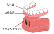 インプラントイメージ3