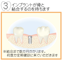 インプラントが骨と結合するのを待ちます