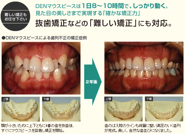 マウスピースイメージ1